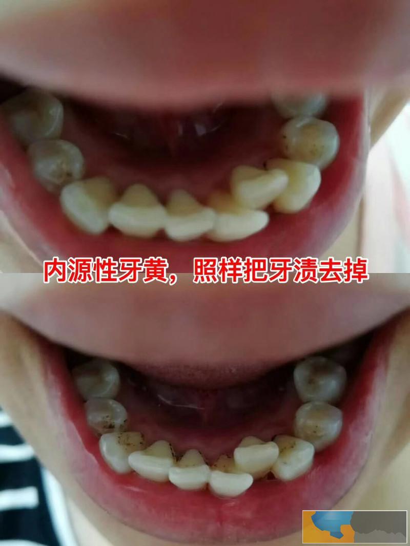 牙齿日常美白神器白牙精华素