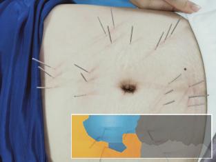 酒泉专业针灸正骨培训多少钱 是否可以考取中医针灸师