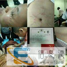 营口哪里有零基础中医针灸培训 一对一教学针灸减肥