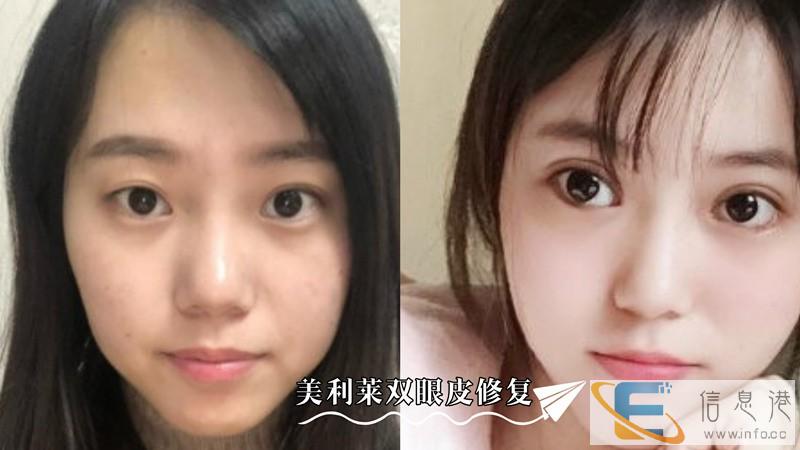 美利莱双眼皮修复术后,终于不用为双眼皮失败感到焦虑